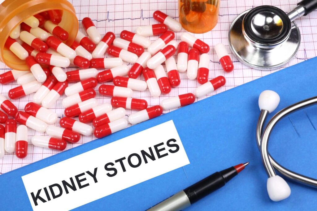 Passing Kidney Stones Symptoms