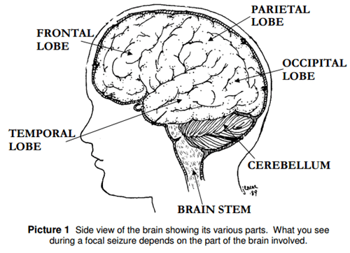 Which Type of Seizure Affects Both Sides of the Brain