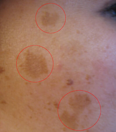 brown spots suddenly appearing on skin